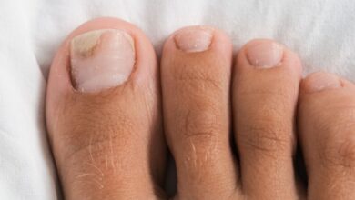 Toenail Fungus