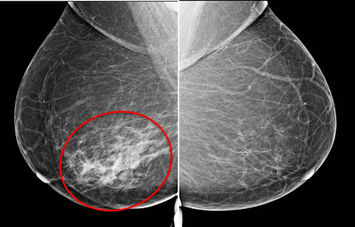 Invasive Breast Cancer